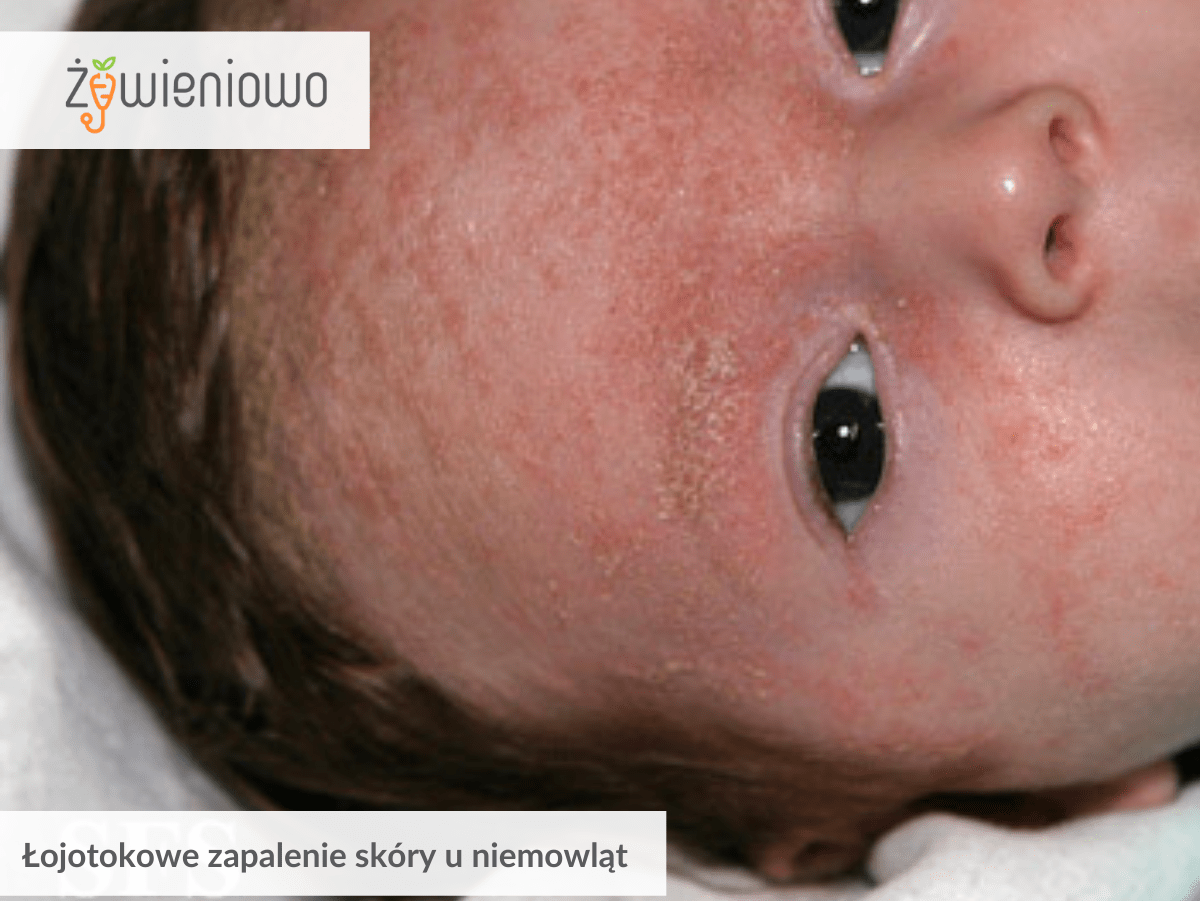 Łojotokowe zapalenie skóry u niemowląt.
